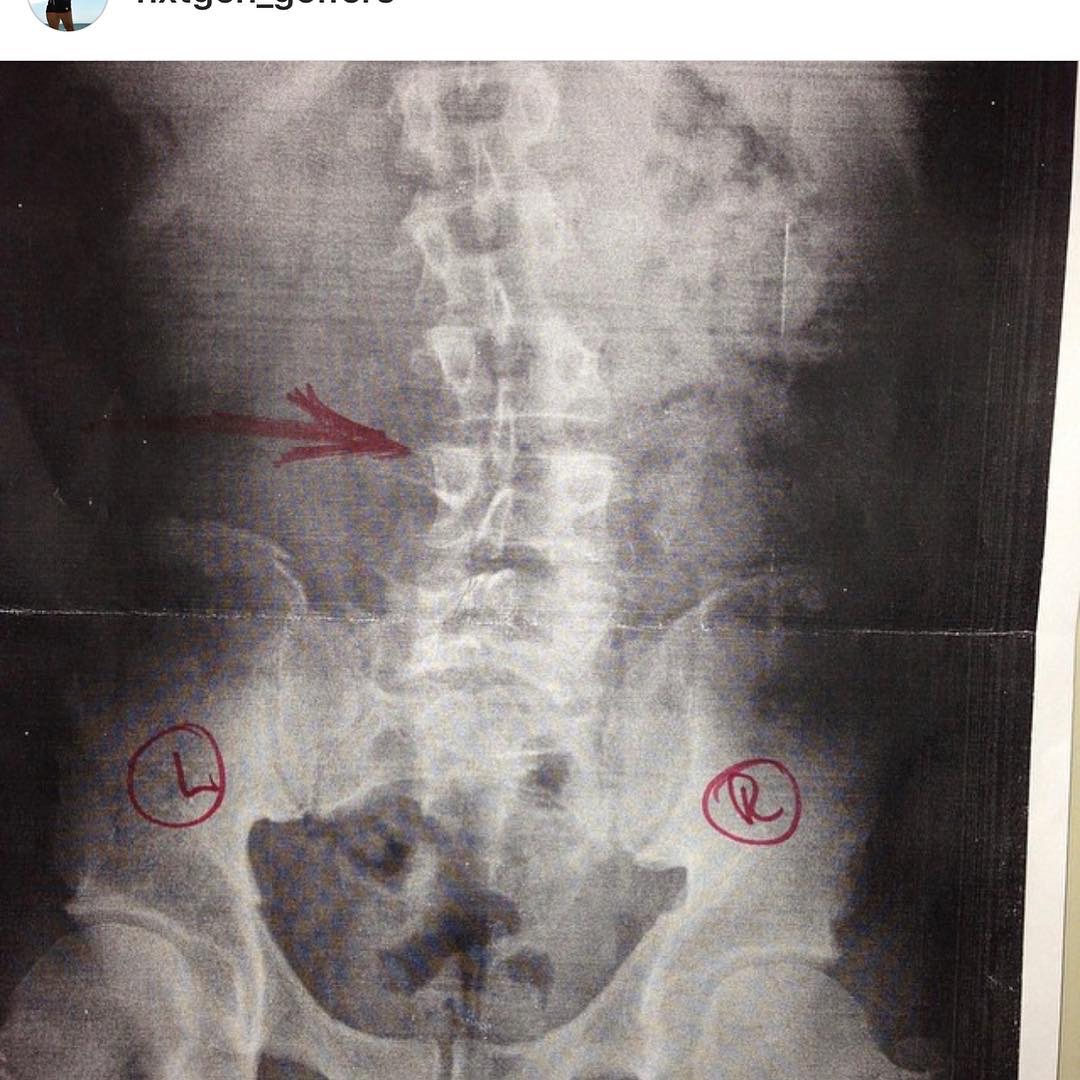 Marked lumbar X-ray showing a visible lateral shift in Eric Pellini&rsquo;s spine